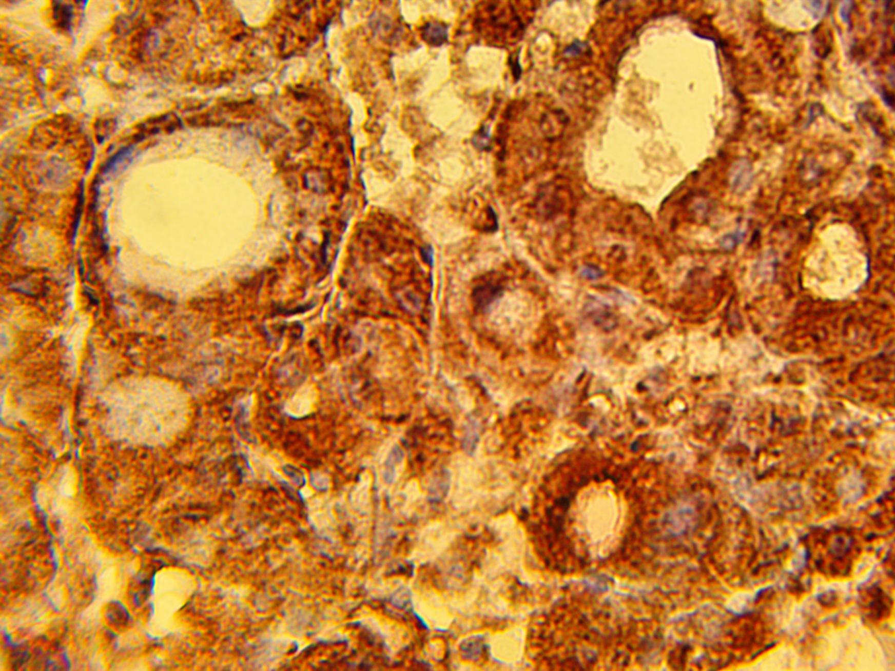 Immunohistochemical staining of human liver tissue diagnosed with hepatocellular carcinoma using RRM1 antibody (Cat. No. X2735P) at 15 µg/ml and detected using anti-Rabbit HRP secondary antibody and visualized using DAB substrate and hematoxylin counterstain.